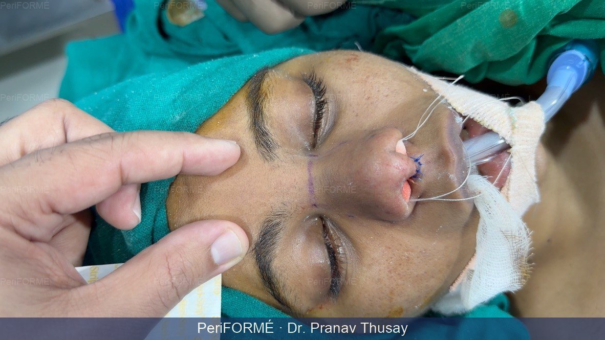 Rhinoplasty — After