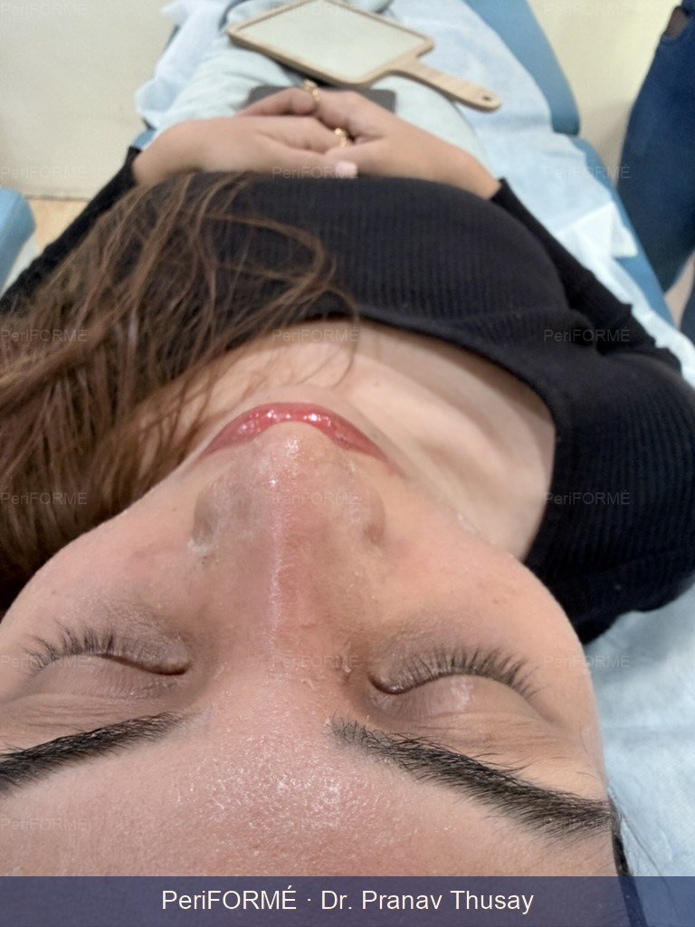 Rhinoplasty Result