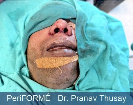 Rhinoplasty - Alar faring correction — After