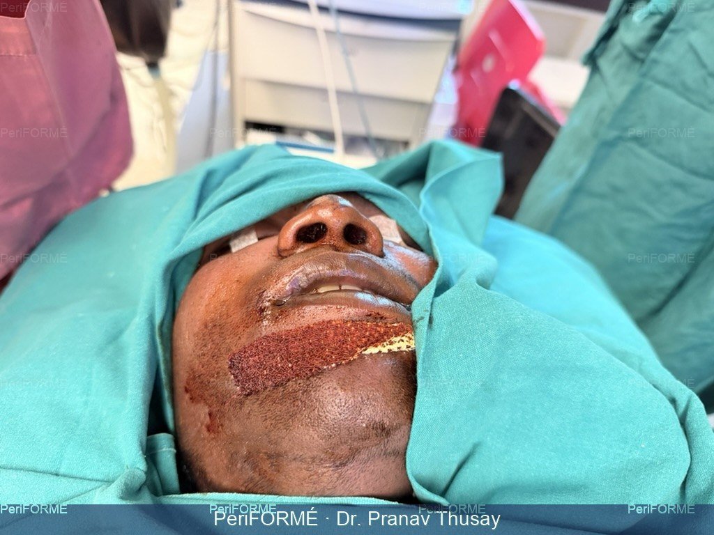 Rhinoplasty - Alar faring correction — Before