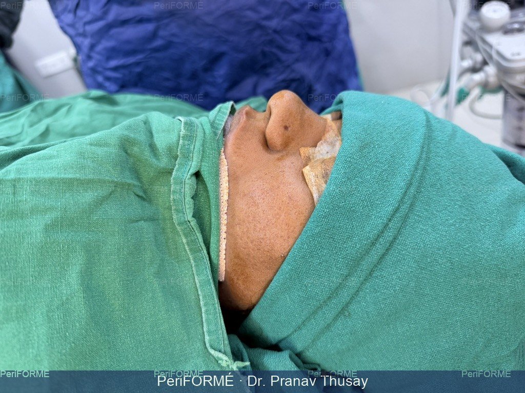 Rhinoplasty — Before
