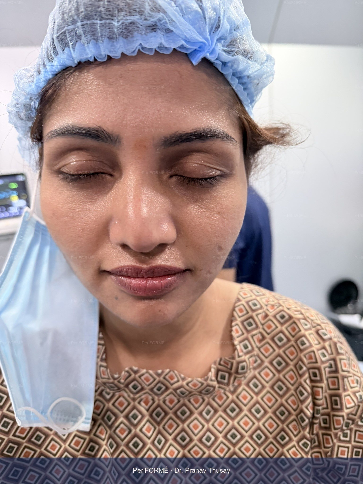 Rhinoplasty — Before