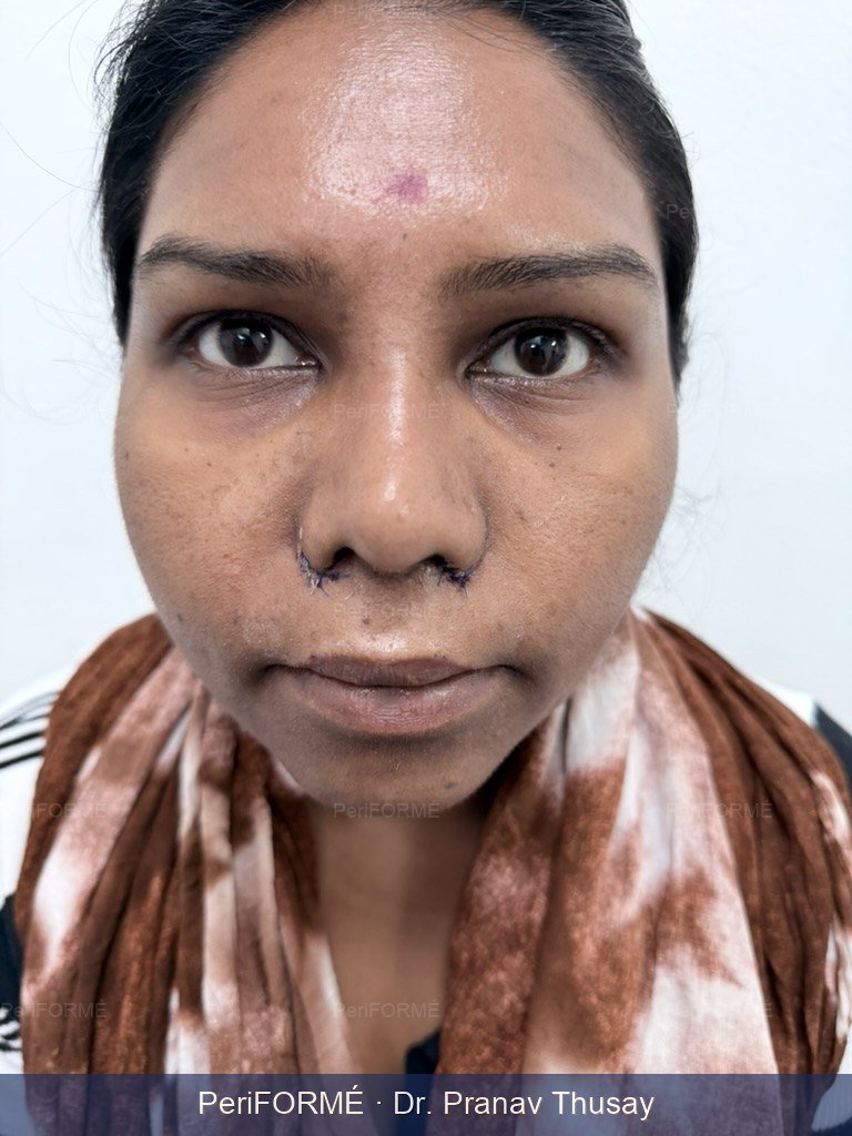 Rhinoplasty - Realignment of nostril height — After