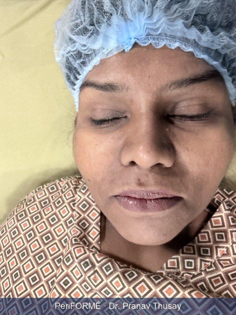 Rhinoplasty - Realignment of nostril height — Before