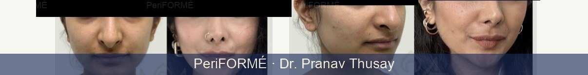 Rhinoplasty surgery