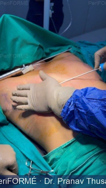 Scarless gynaecomastia surgery