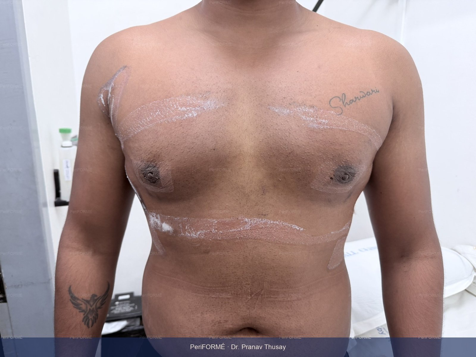 Scarless gynaecomastia surgery — After