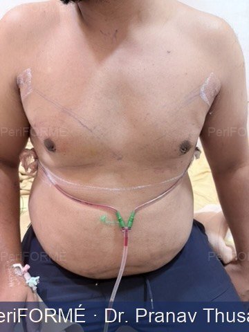 Scarless gynaecomastia surgery --> liposuction + Chest sculpting — After