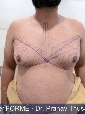 Scarless gynaecomastia surgery --> liposuction + Chest sculpting — Before