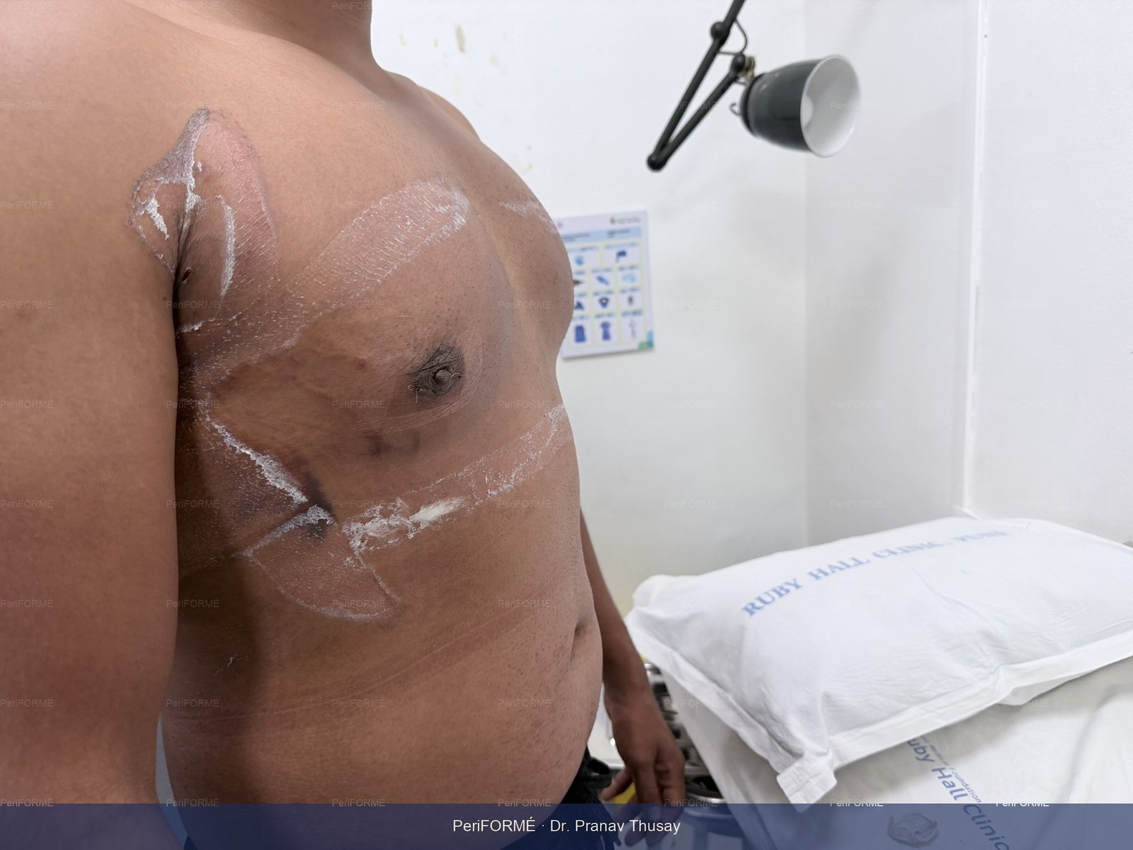 Scarless Gynaecomastia surgery (Male Breast surgery ) — After