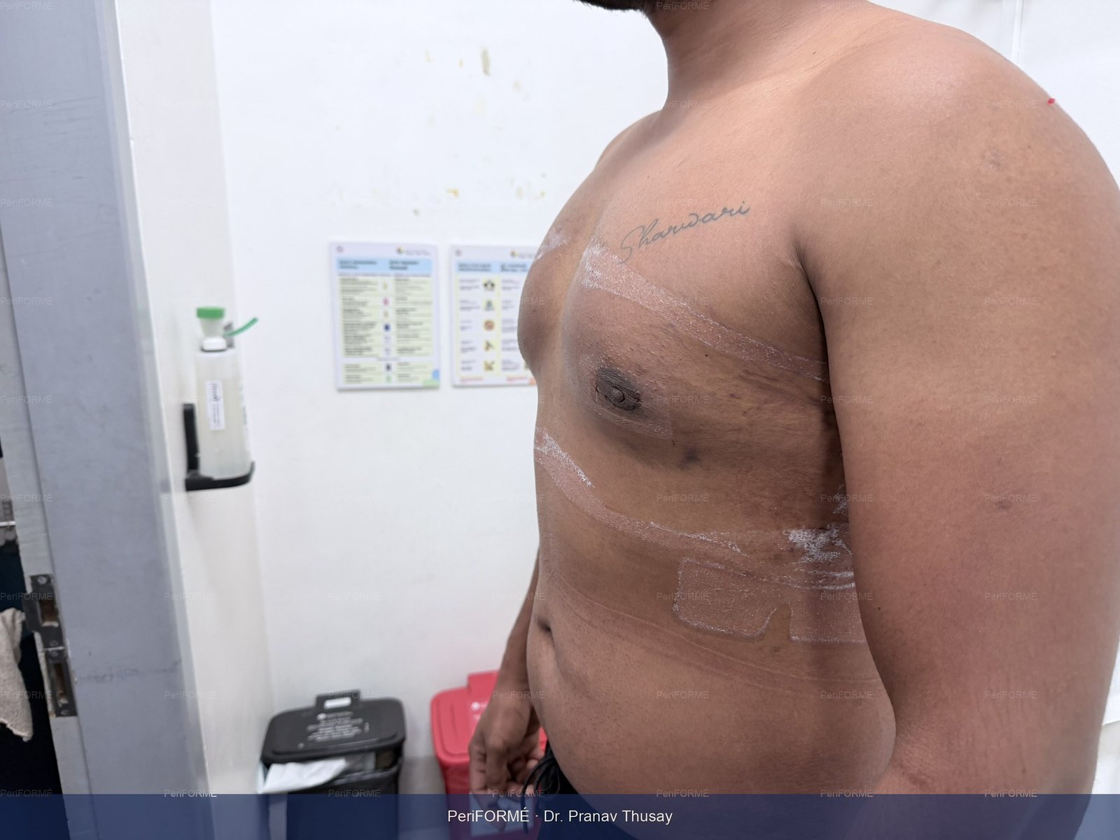 Scarless Gynaecomastia surgery (Male Breast surgery ) — After