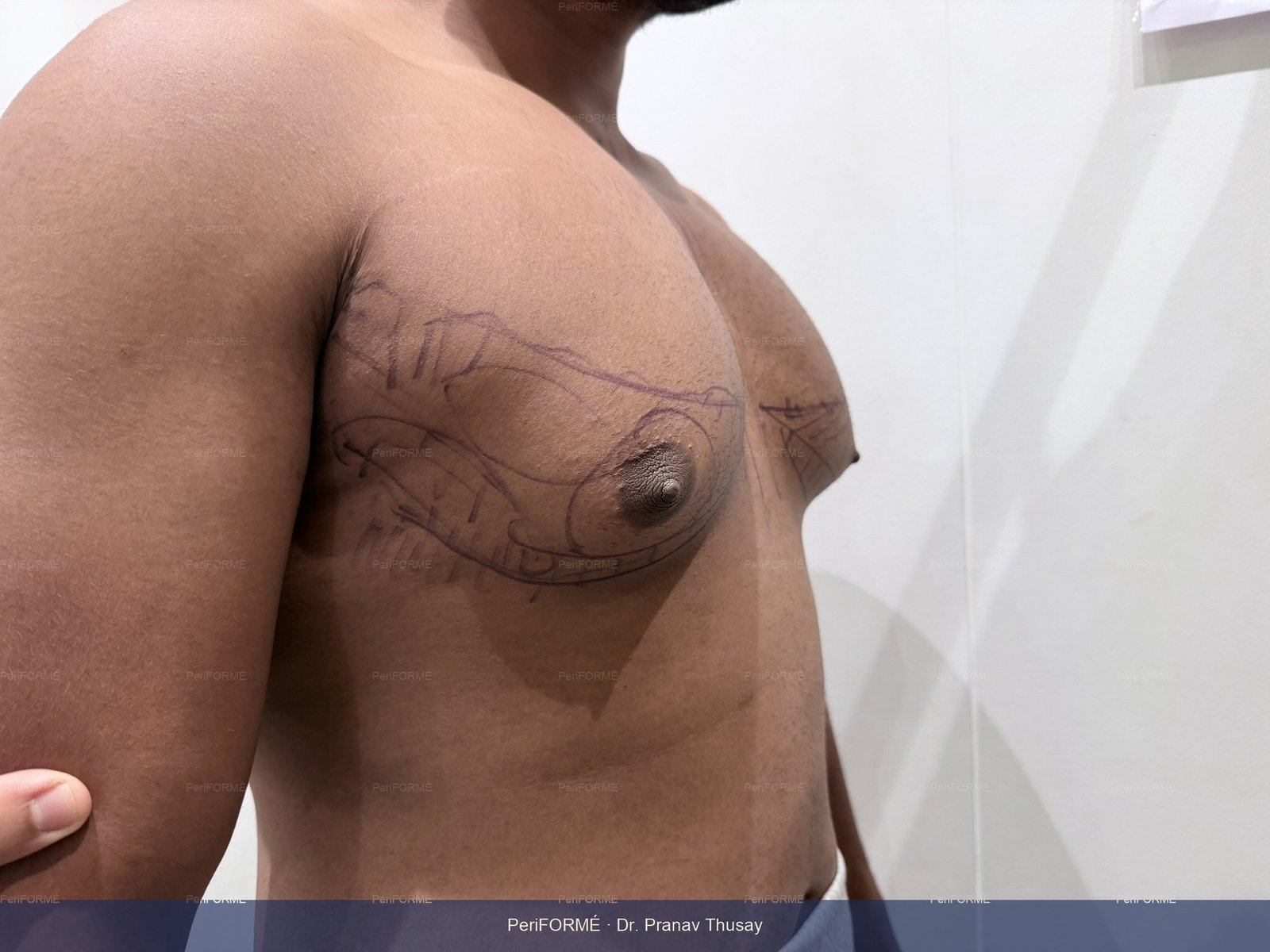 Scarless Gynaecomastia surgery (Male Breast surgery ) — Before