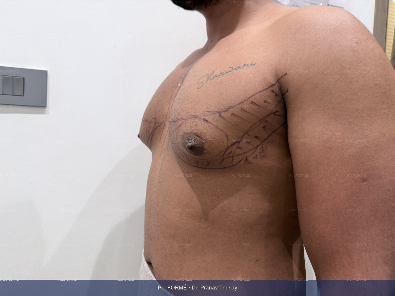 Scarless Gynaecomastia surgery (Male Breast surgery ) — Before