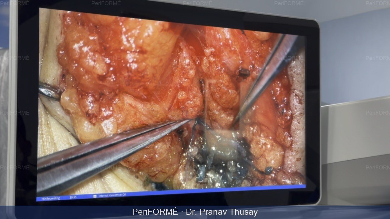 Small diameter lymphatic vessels - 0.3 mm - This can prevent / treat Lymphedema — Before