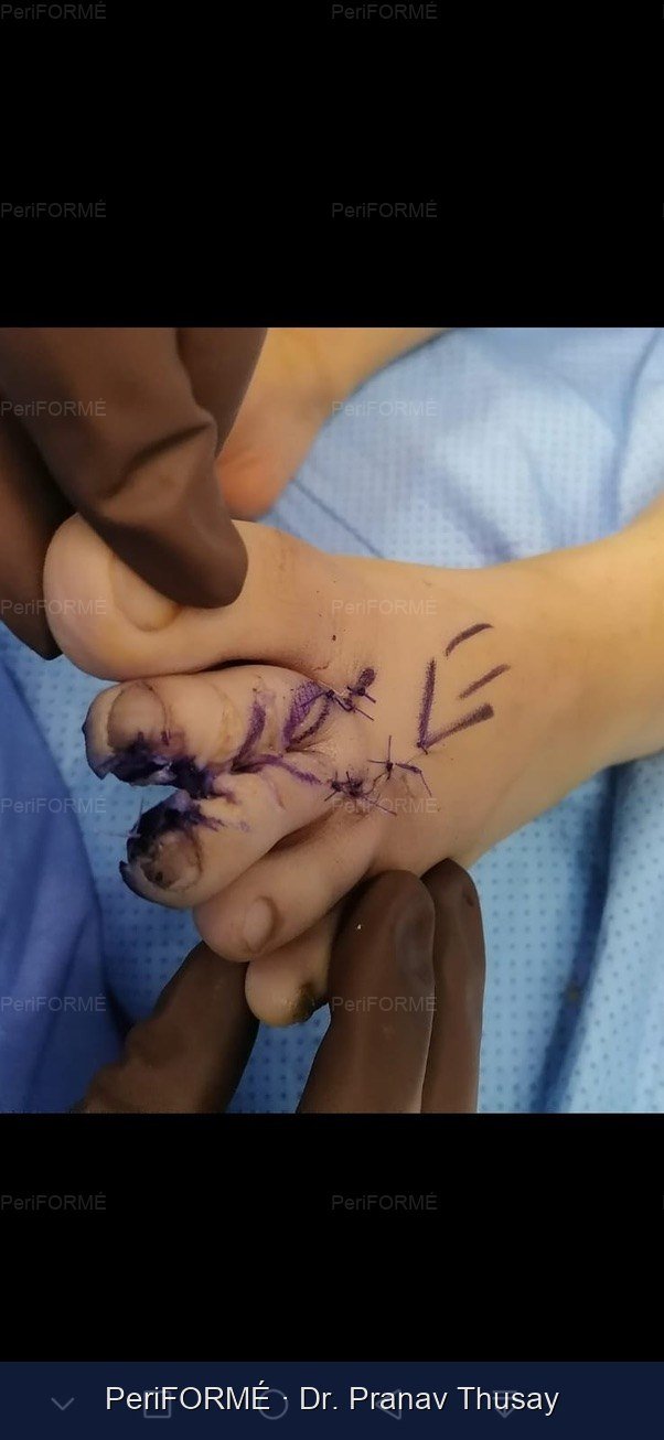 Syndactyly - Joined toes correction — After