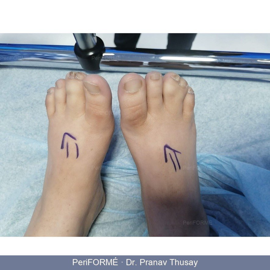 Syndactyly - Joined toes correction — Before