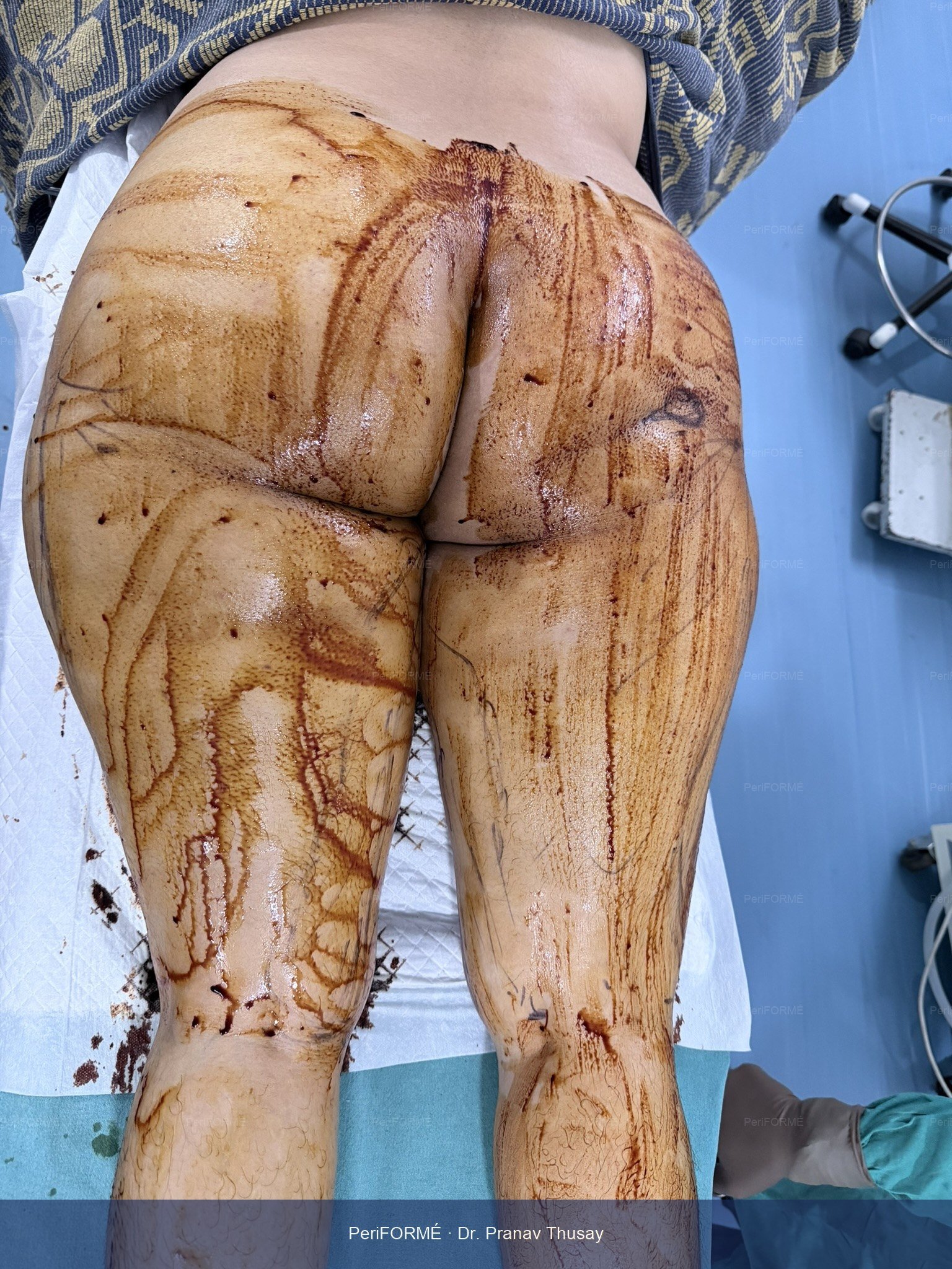 Thigh liposuction - body Countouring — Before