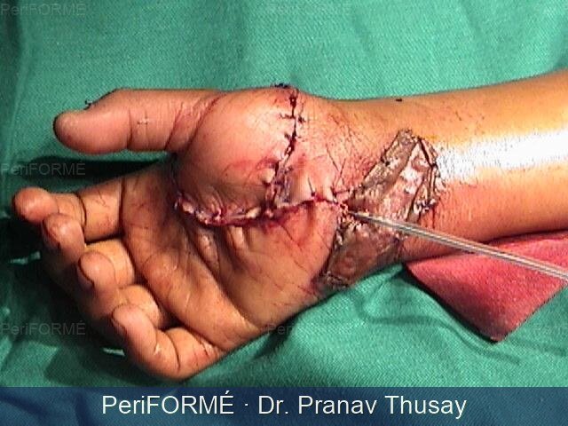 Thumb replantation — After