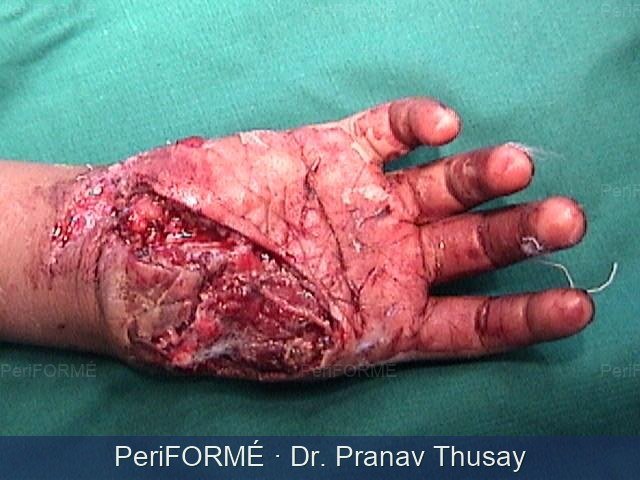Thumb replantation — Before