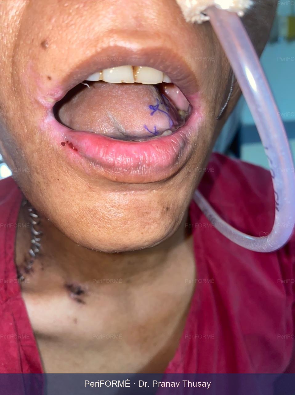 Tongue reconstruction