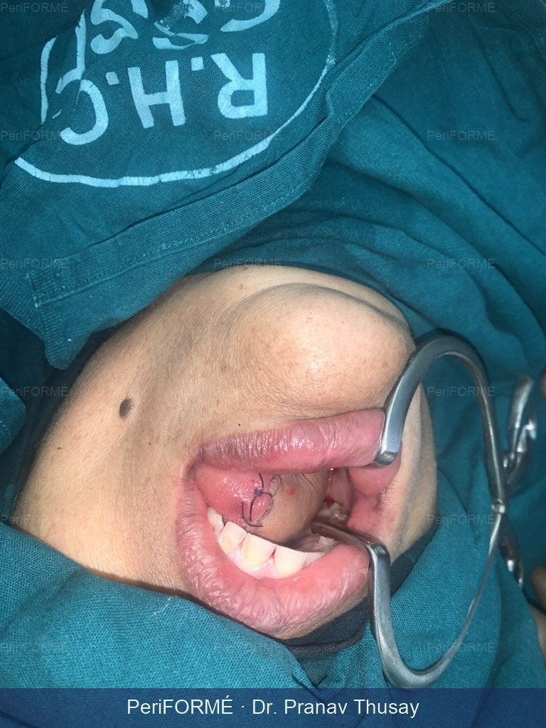 Tongue reconstruction