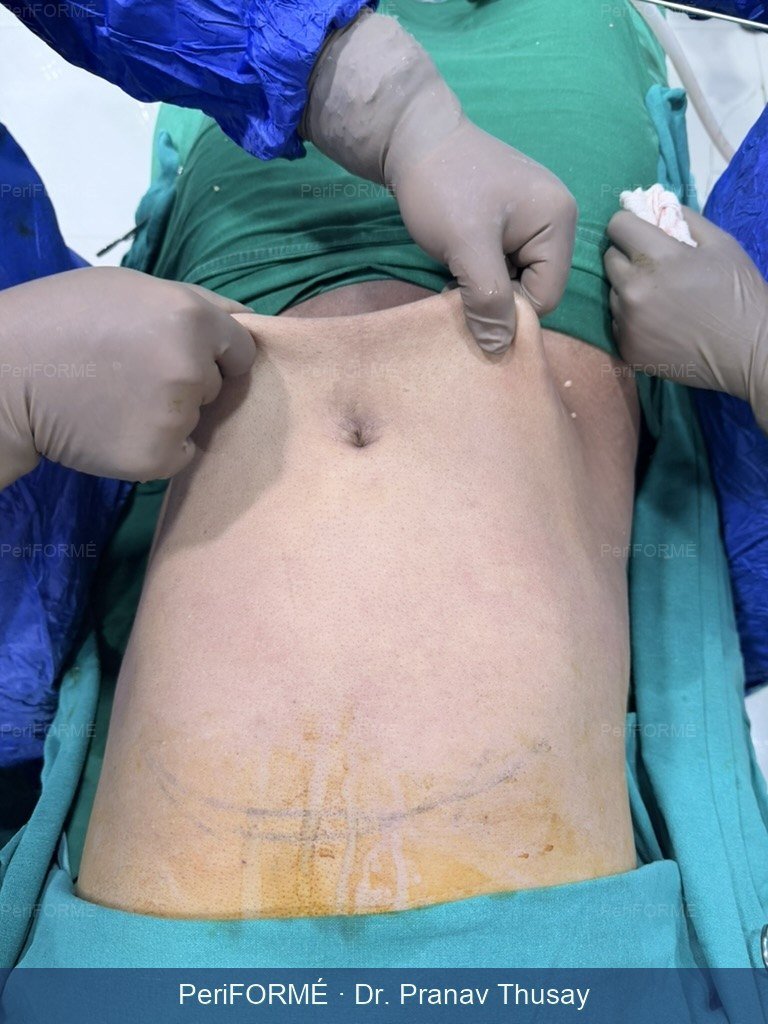 Tummy liposuction — After