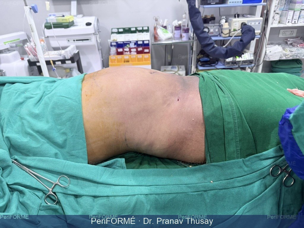 Tummy liposuction — After