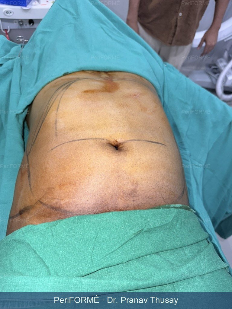 Tummy liposuction — Before
