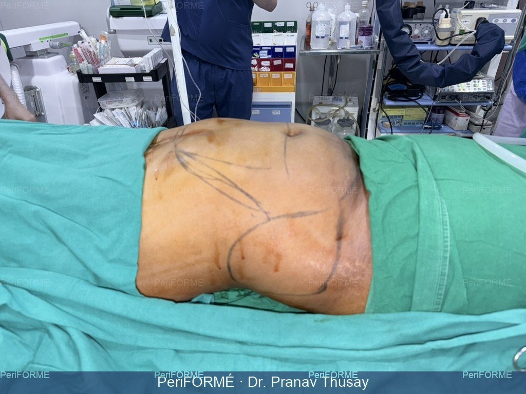 Tummy liposuction — Before