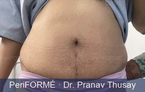 Tummy tuck and liposuction — After
