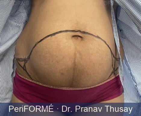 Tummy tuck and liposuction — Before