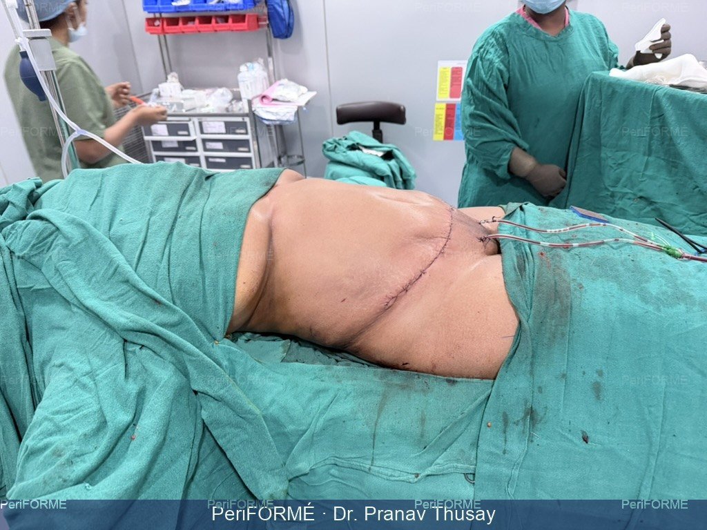 Tummy tuck - flat abdomen — After