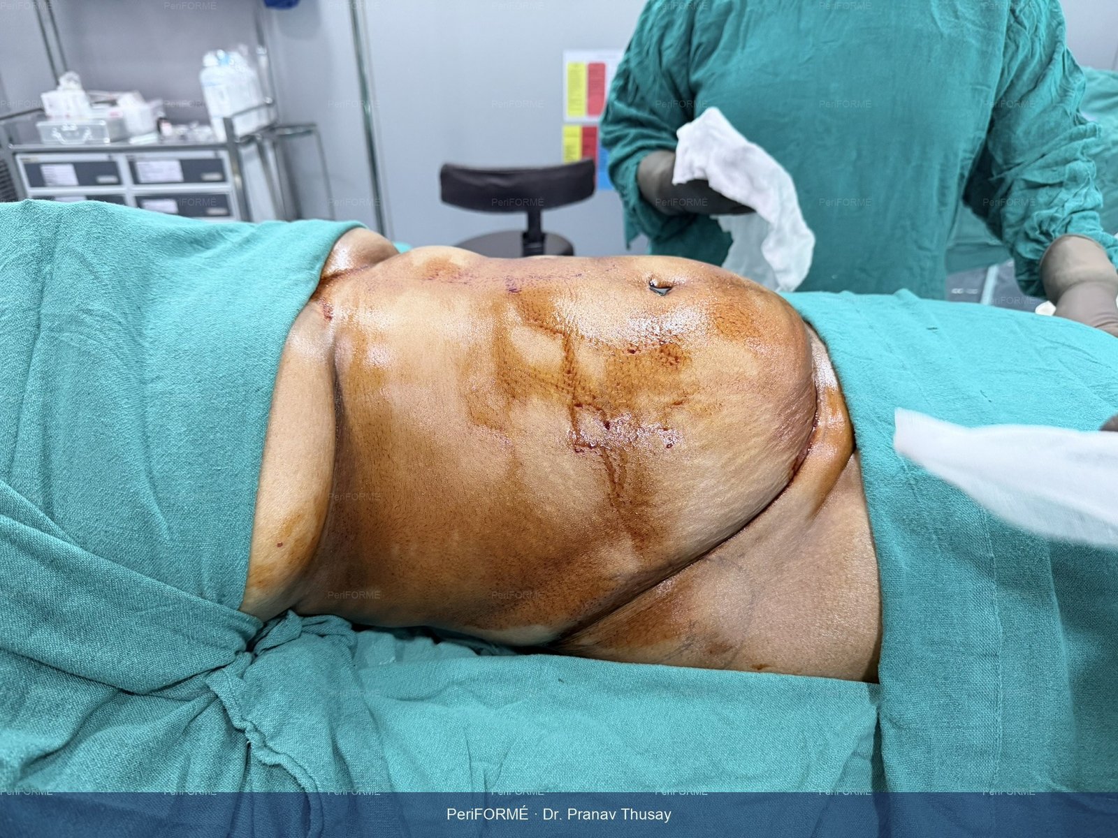 Tummy tuck - flat abdomen — Before