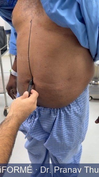 Tummy tuck markings