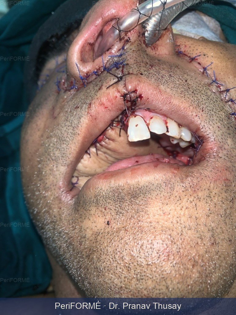 Upper jaw - maxilla reconstruction