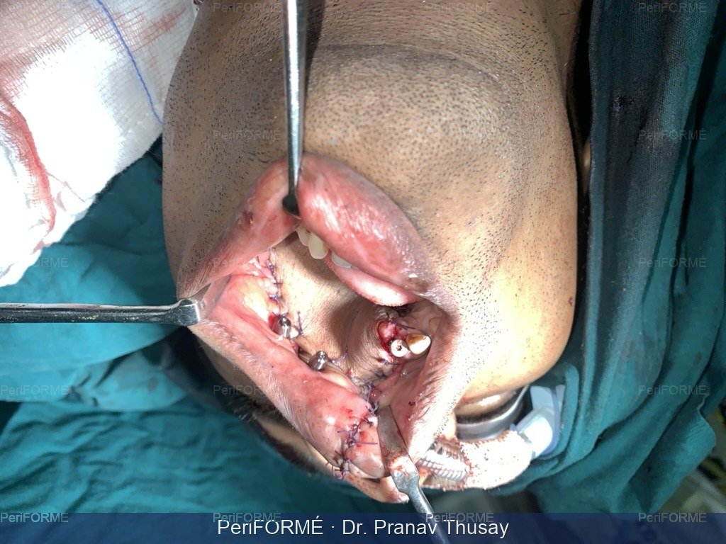 Upper jaw surgery - with zygomatic implants