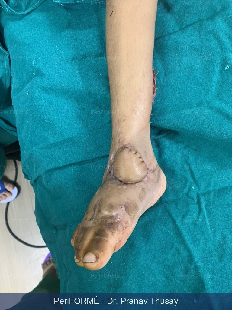 Wound and exposed bone coverage — After