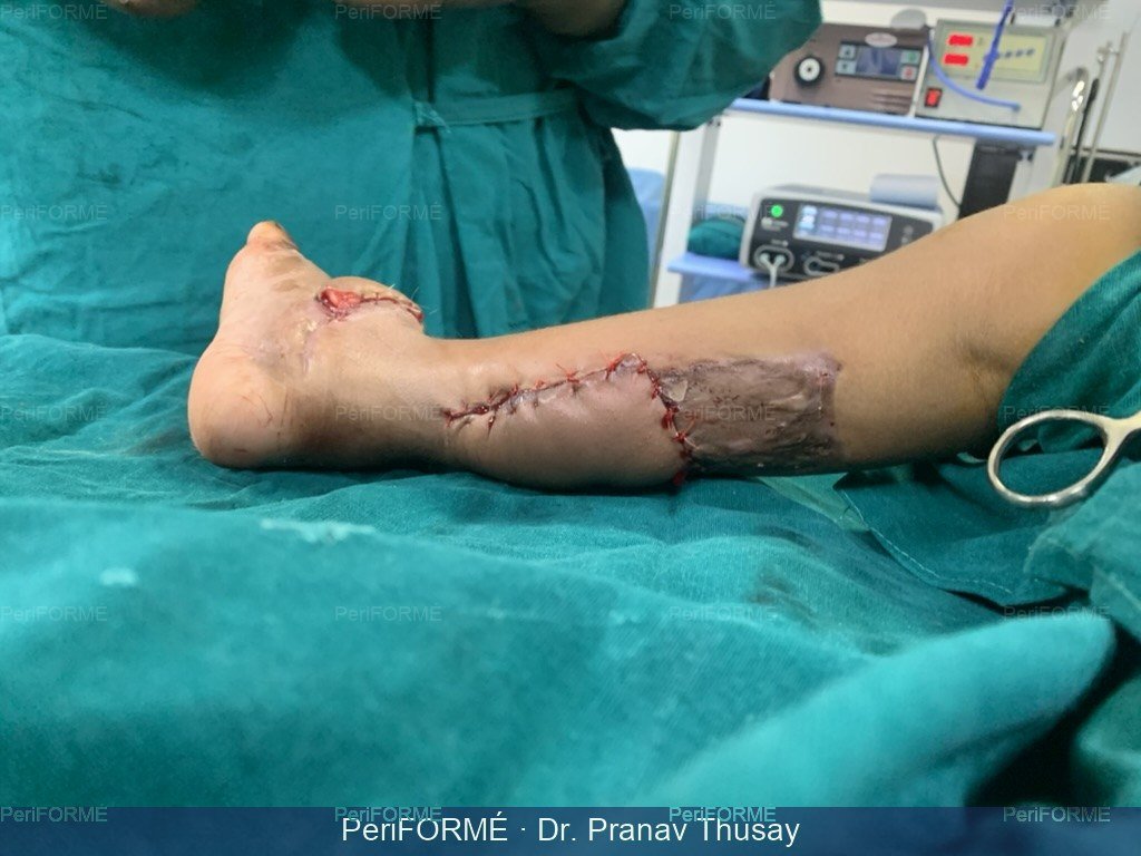 Wound and exposed bone coverage — Before