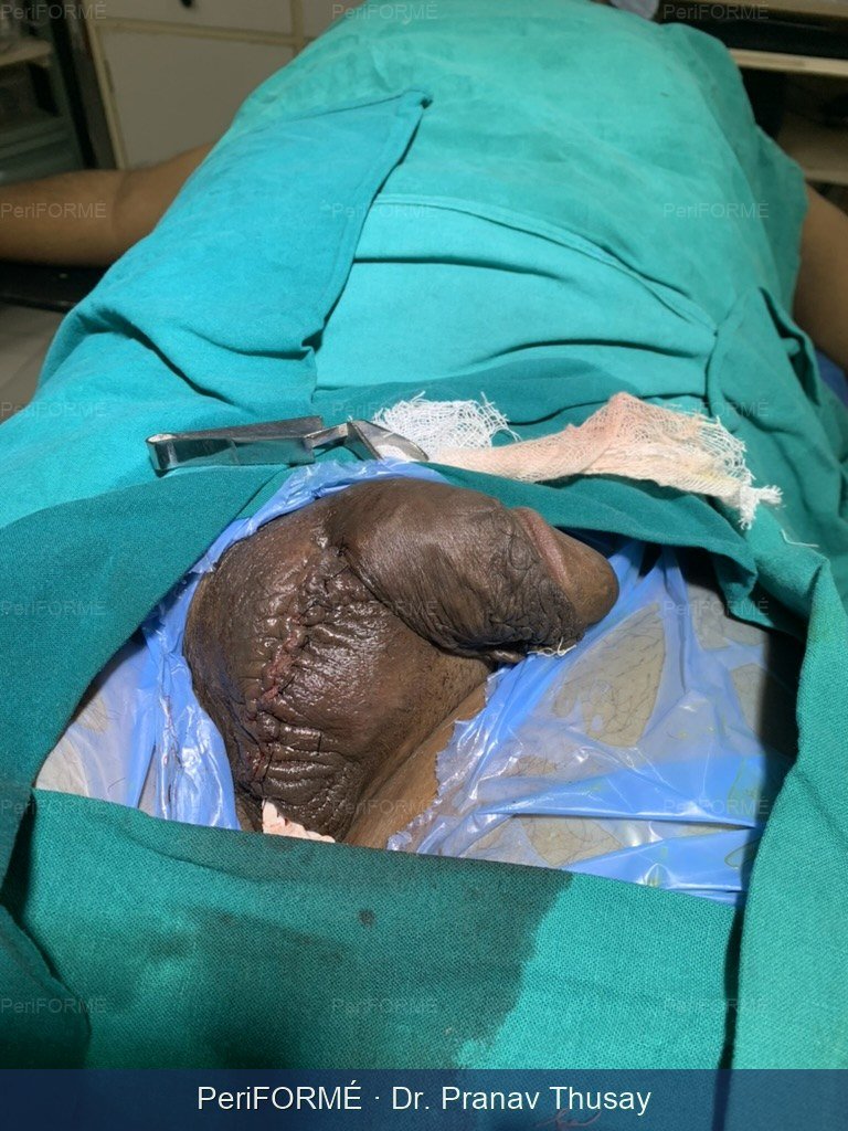 Wound coverage — After