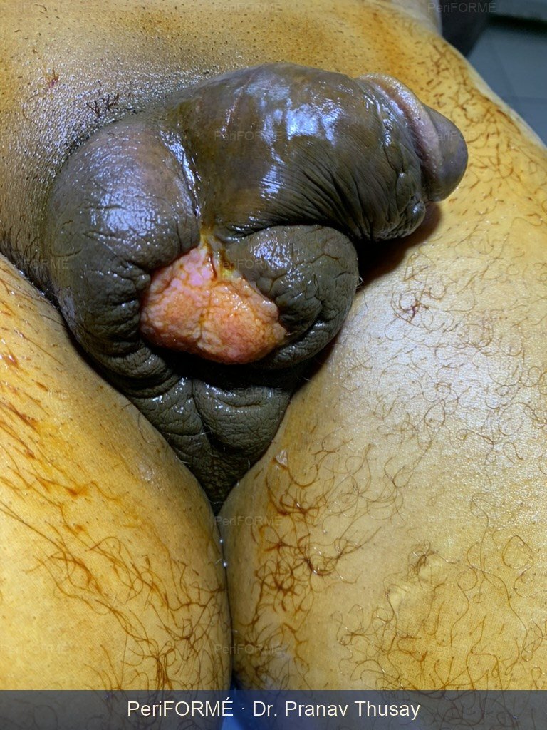Wound coverage — Before