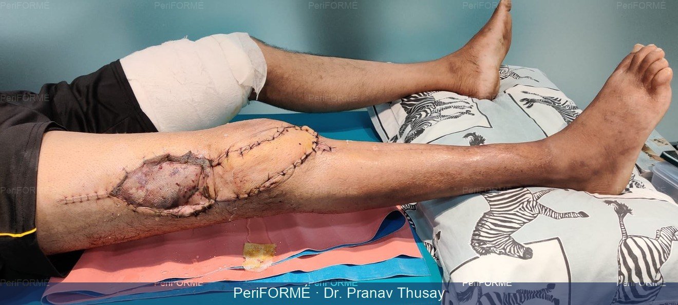 wound coverage with flap — After