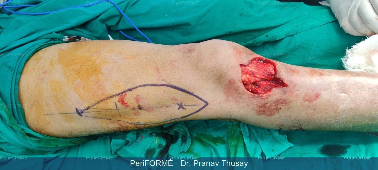 wound coverage with flap — Before